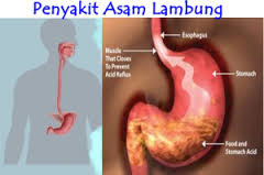gejala asam lambung