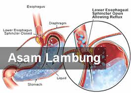 Asam Lambung Tinggi